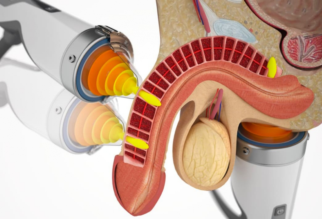 Ударно-волновая терапия