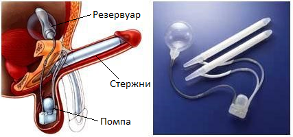 Надувной протез